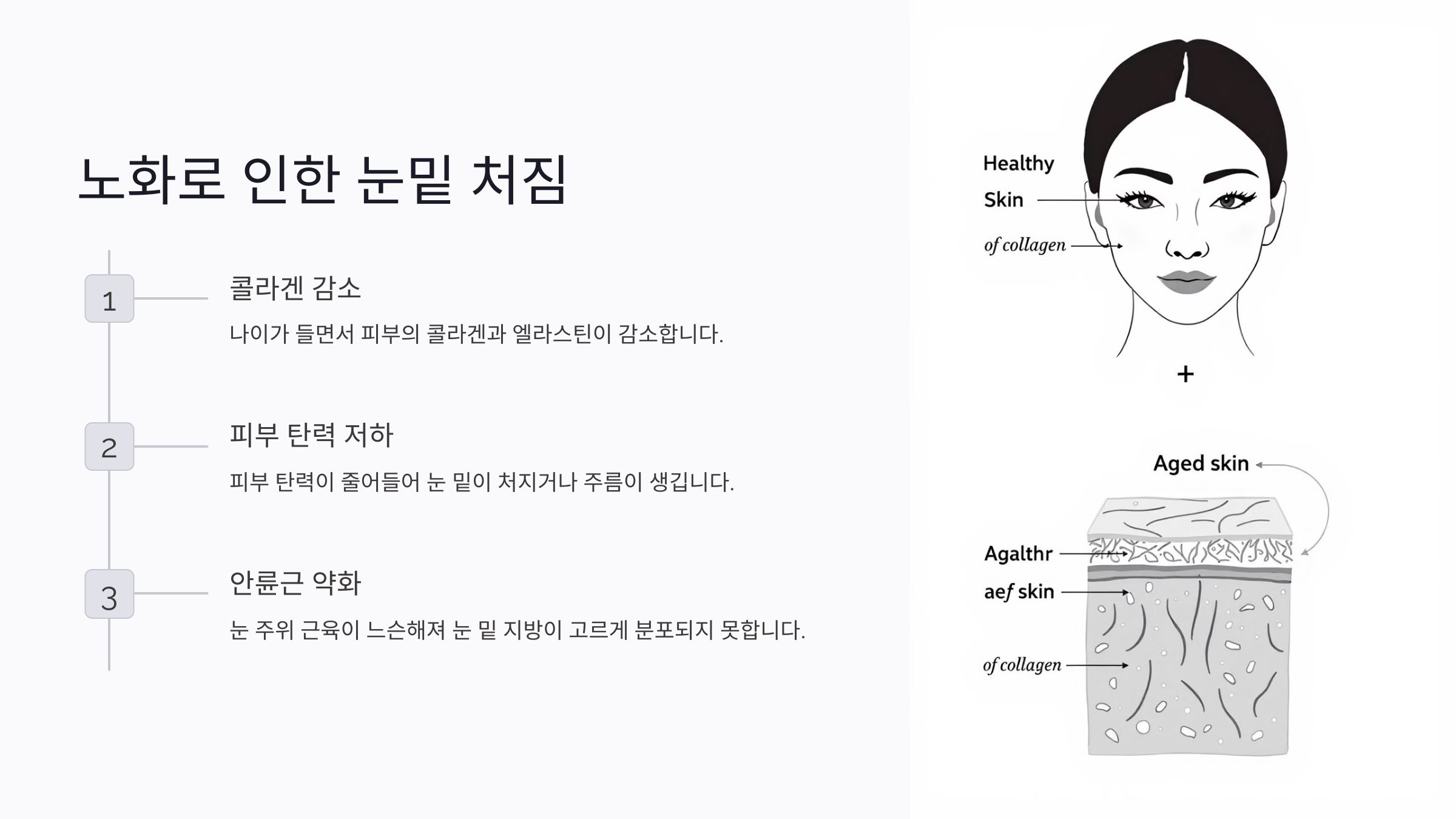 쳐진 눈