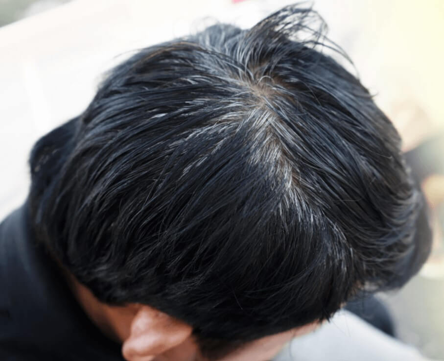 탈모 예방 혈자리