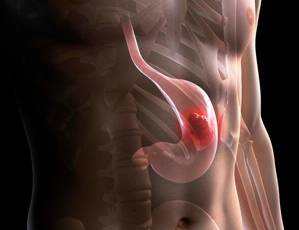 젊은 여성에게 더 무섭다는 &lsquo;보르만 4형 위암&rsquo;&hellip; 왜 발견이 늦을까?