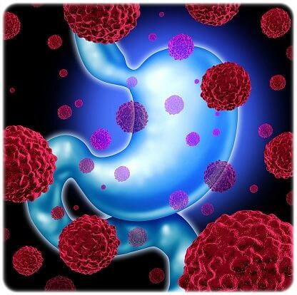 위암 증상 원인 진단 치료 생존율 완치율 예방 방법