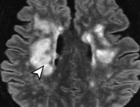 섬망 증상에 좋은 영양제
