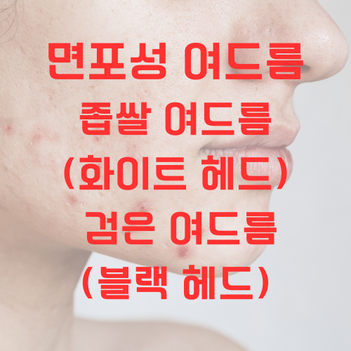 여드름 종류 면포성 여드름