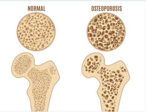 골다공증 예방을 위한 칼슘 섭취와 운동