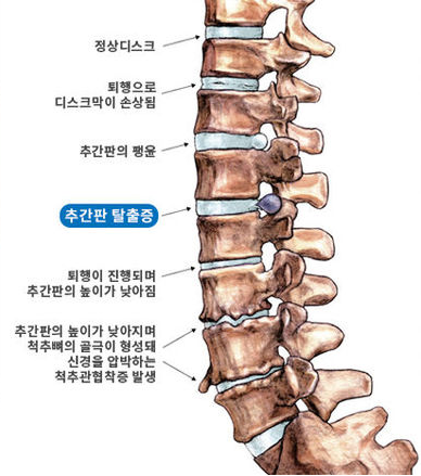 허리디스크 증상