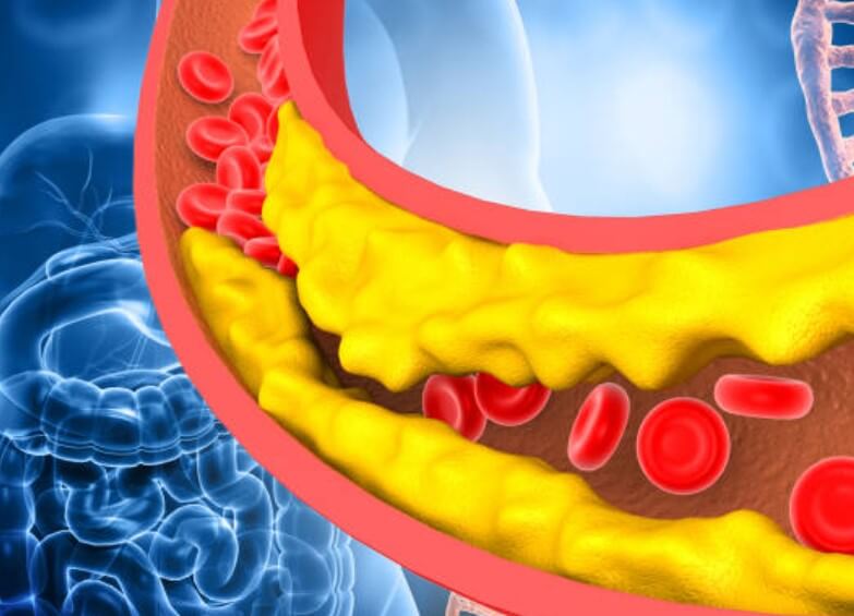 고지혈증약 부작용
