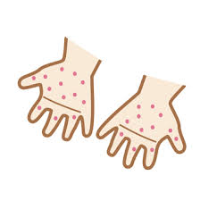 대상포진 초기증상 10가지