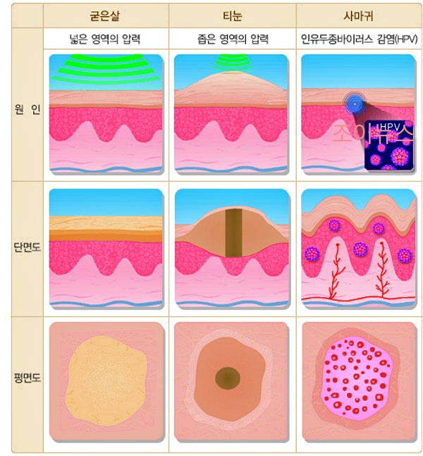 외형의 차이_출처:국가건강정보포털