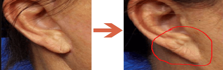 칼귀 현상 모습