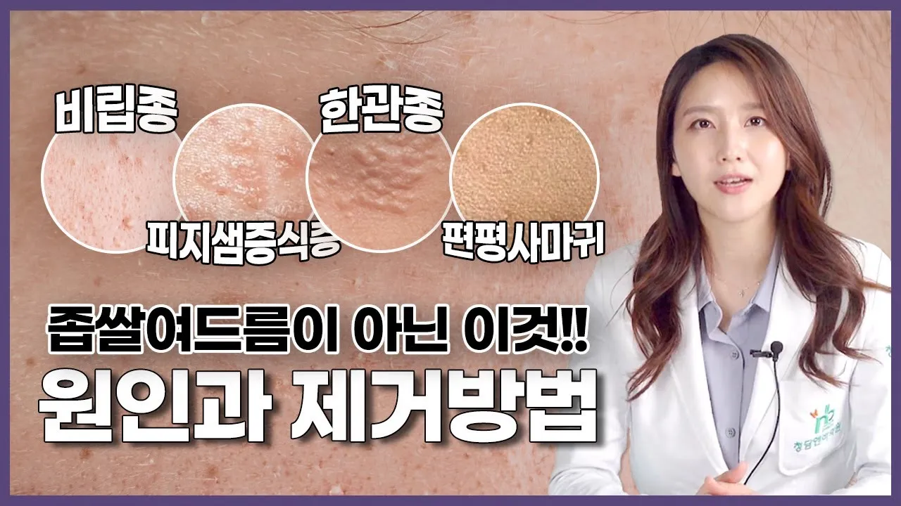 비립종 생기는 이유 비립종 없애는 방법 피부 관리법_6