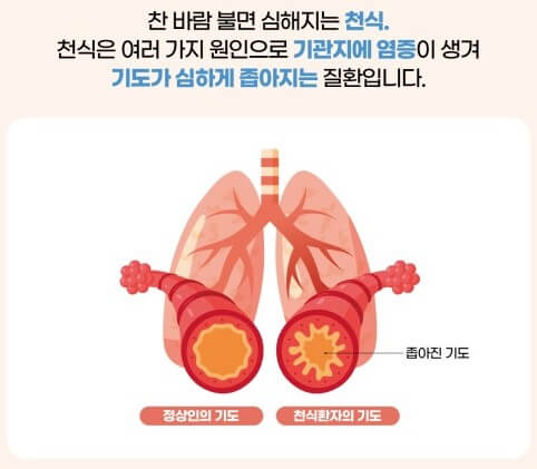 천식과 기도