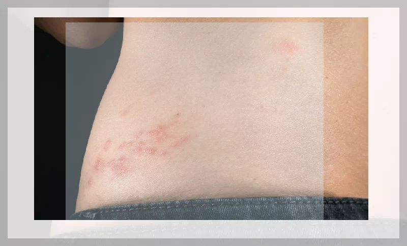 옆구리 대상포진