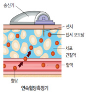 연속혈당측정기 원리=삼성서울병원