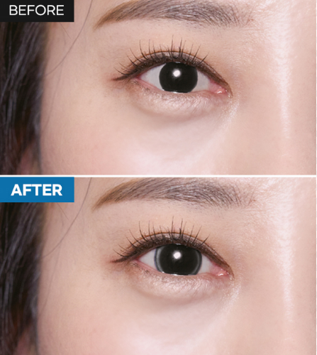 아이링수술, 아이링수술후기, 써클렌즈 대체, 눈동자확대수술, 미용성형, 안과 시술, 렌즈부작용