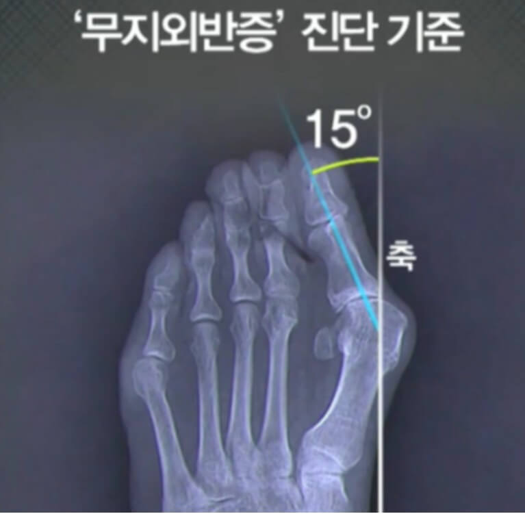 무지외반증은 각도가 15도 이상부터