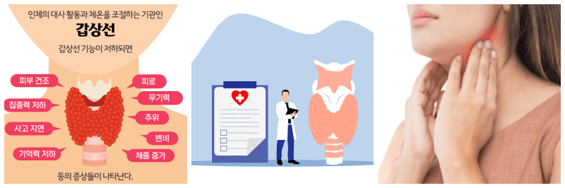 갑상선 기능 저하증 관련 사진 3개