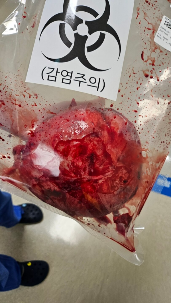 거대자궁근종크기