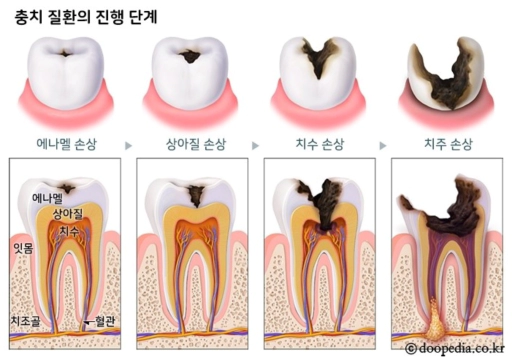 충치의 진행 단계 이미지