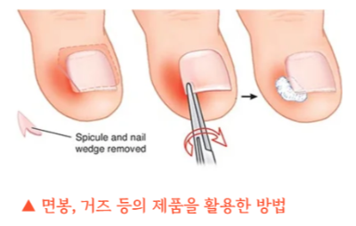 내성-발톱-자가-치료