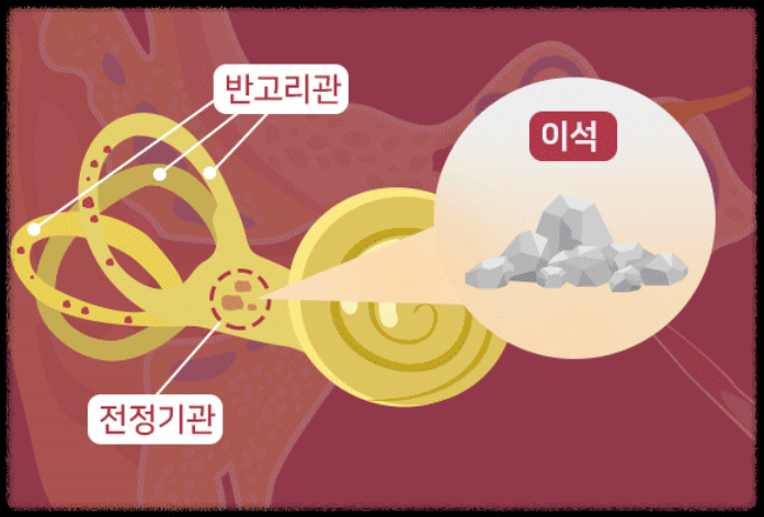 어지럼증 치료 약 어지럼증에 좋은 음식