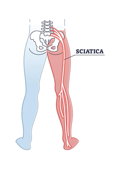 궁둥신경 혹은 좌골신경으로 불리는 Sciatic Nerve의 그림