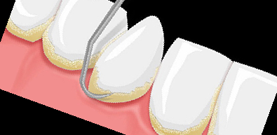 잇몸 내려앉음 치료