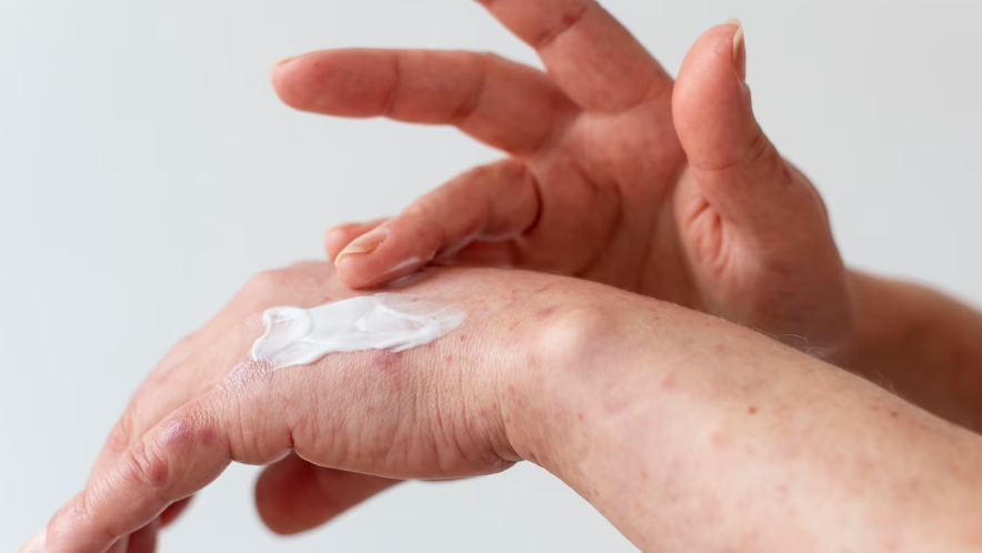 아토피 피부염의 치료방법