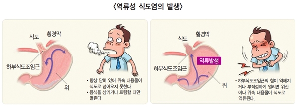 역류성 식도염 목 통증&amp;#44; 삼킬 때 불편한 이유