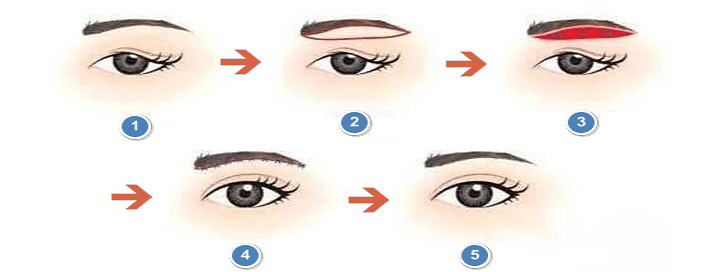 눈썹하거상술 순서와 달라진 효과