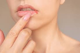 입술 포진 빨리 낫는법