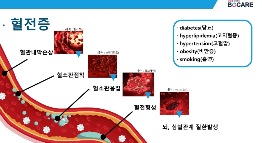 혈전이란