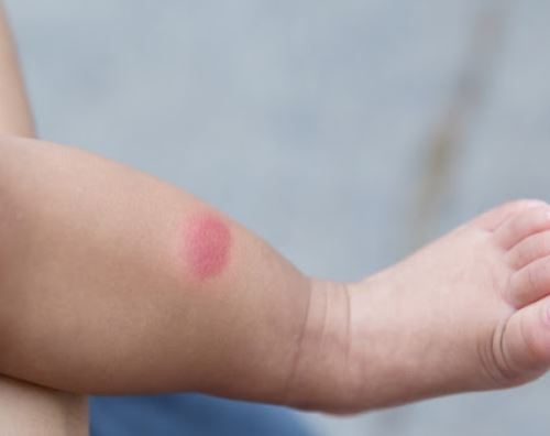 아이유-스키터증후군