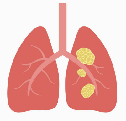 폐암 초기증상, 폐암에 좋은 음식 알아보기!