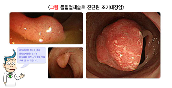 조기대장암