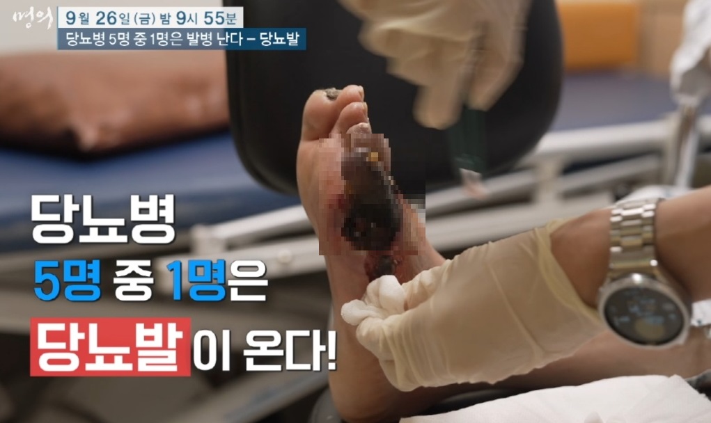 EBS-명의-당뇨발-천동일-교수-족부-정형외과