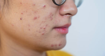 화농성 여드름