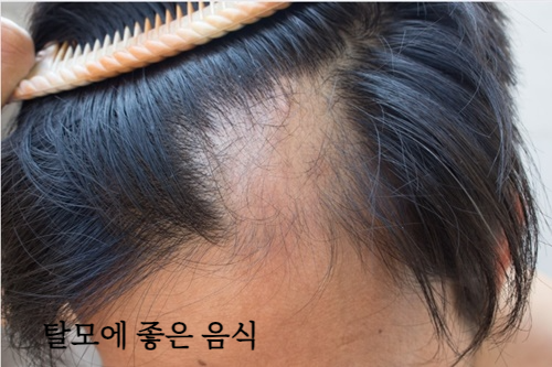 탈모에 좋은 음식 알아보기&amp;#44; 탈모 원인