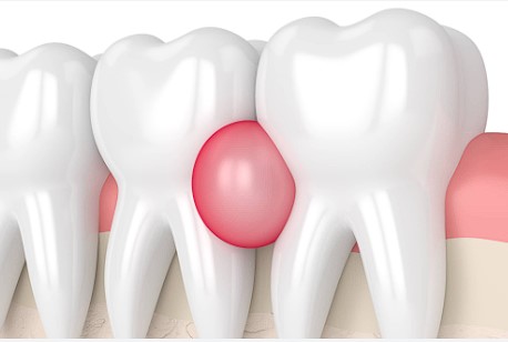 잇몸-고름주머니