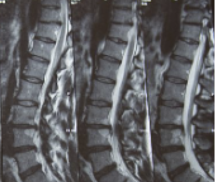 허리디스크 증상