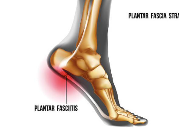 발바닥 통증부위