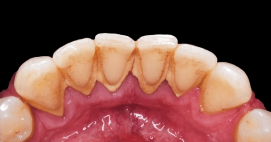 이빨의 안쪽에 불순물인 누런 치석이 많이 끼어 있는 것을 확대를 하여 찍은 사진