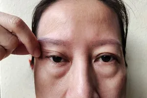 하안검-수술-회복기간