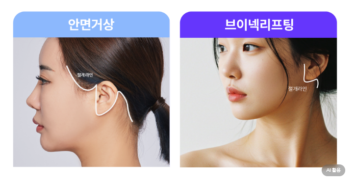 신사역성형외과 브이넥리프팅