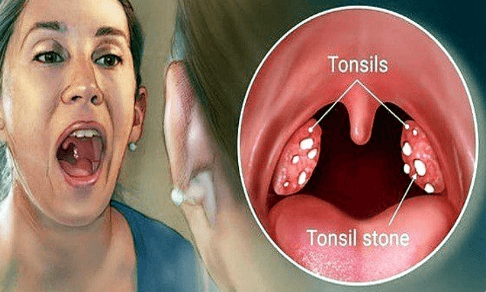 편도결석 생성 위치와 형태
