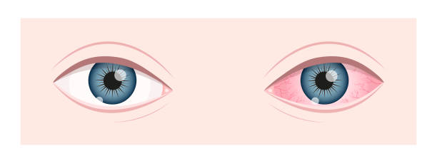 안구건조증 가장 흔한 눈물이 많은 이유