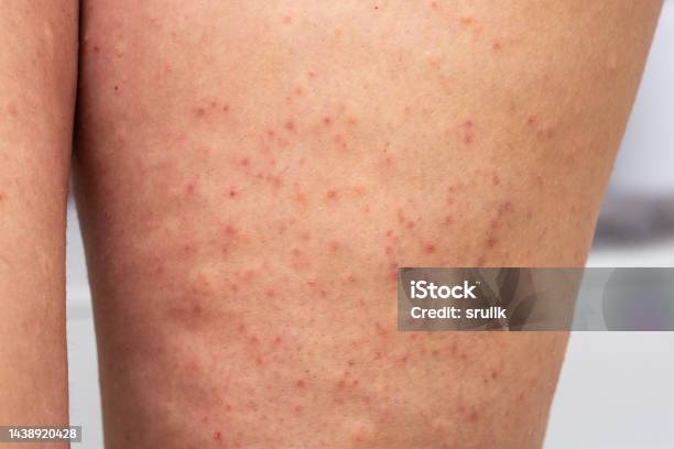 모공각화증 관련 사진