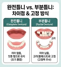 완전틀니 부분틀니