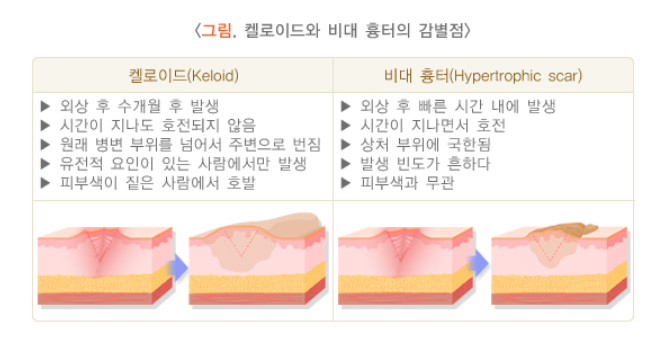 켈로이드와 감별법