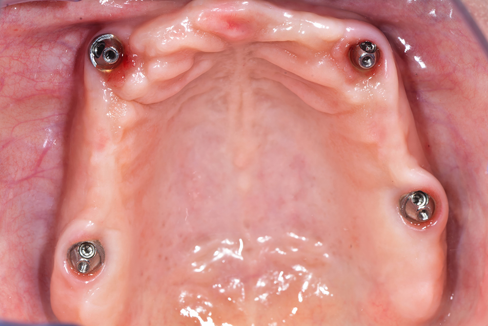 전체 임플란트 가격