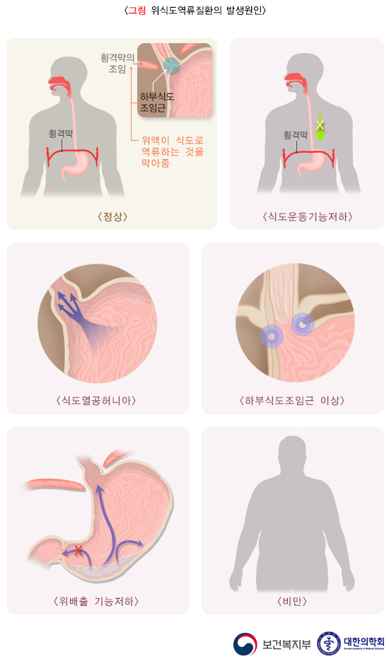 위식도 역류 질환의 원인과 증상, 진단, 치료와 예방 방법, 합병증