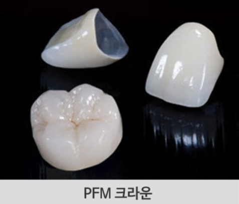 즉시 임플란트